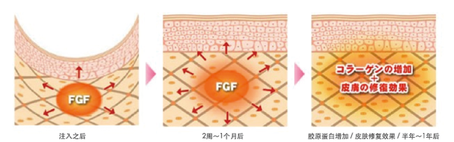 肌肤再生FGF注射疗法